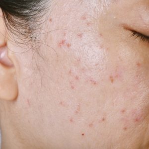 maladie inflammatoire