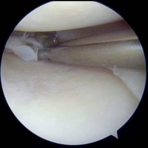 chirurgie du ménisque