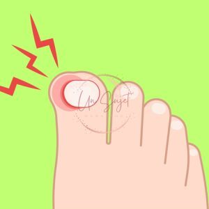 traiter mycoses