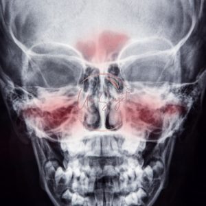 La sinusite : causes, symptômes et traitements