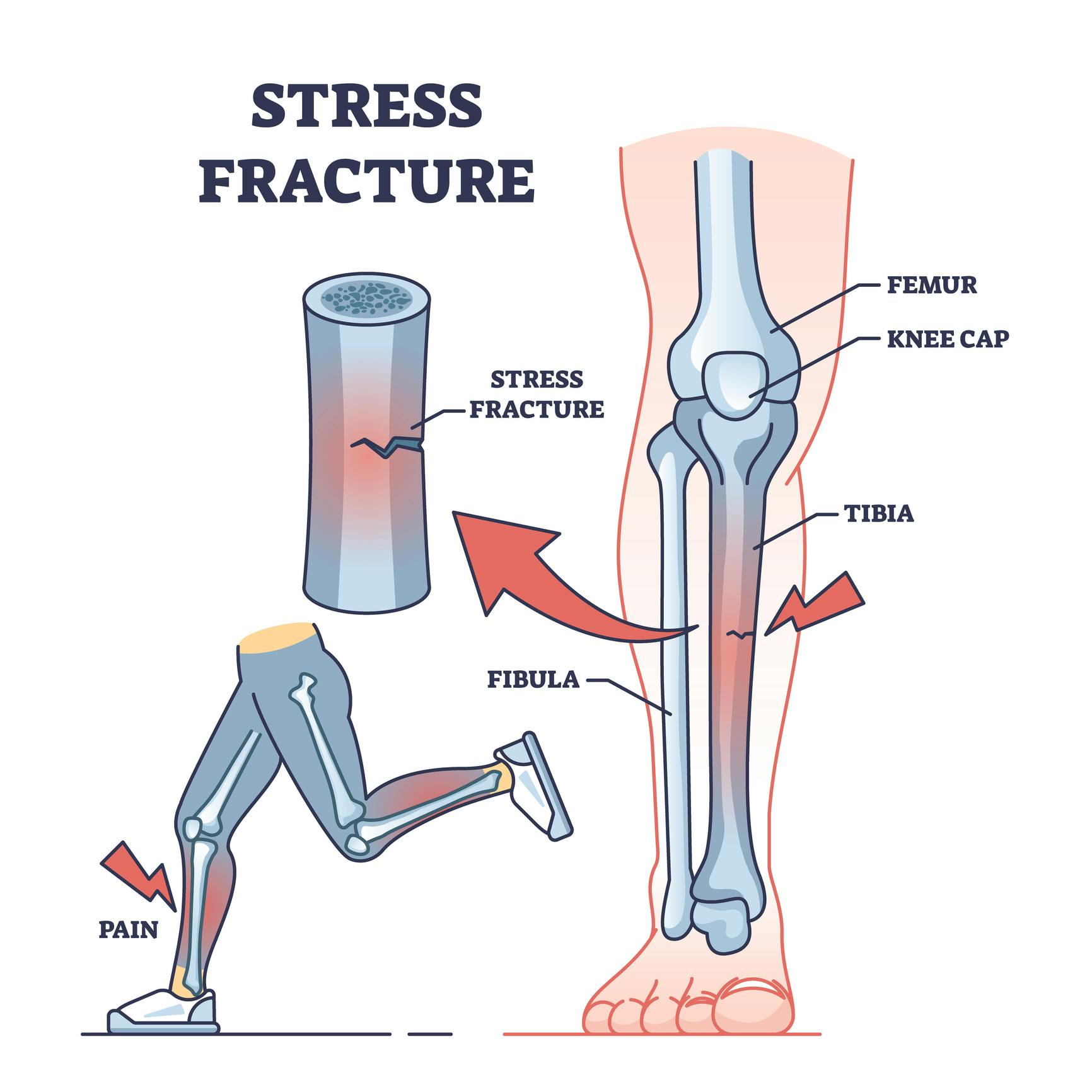 schéma Fracture de l'os du péroné