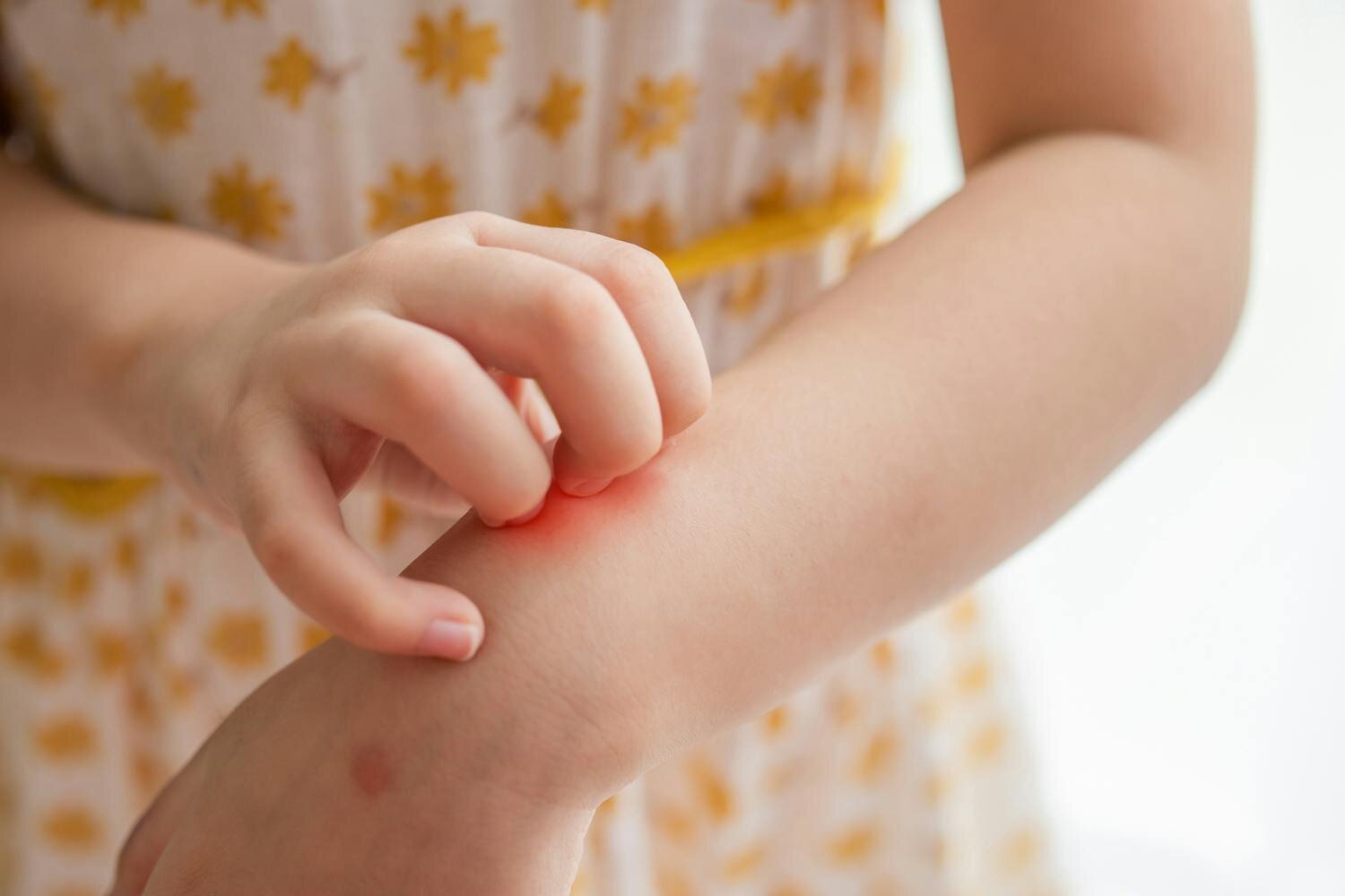 Reconnaître les signes d'allergie aux piqûres de moustique One Media — free download