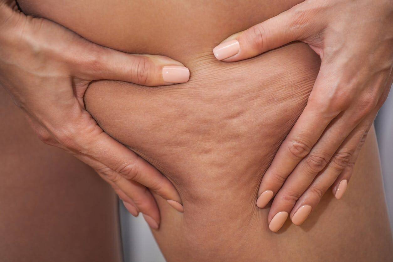 Test : quel est votre type de cellulite ?