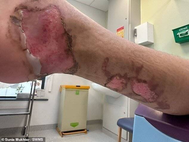 Une fille de huit ans a subi de graves brûlures après avoir préparé du chocolat chaud à l'école