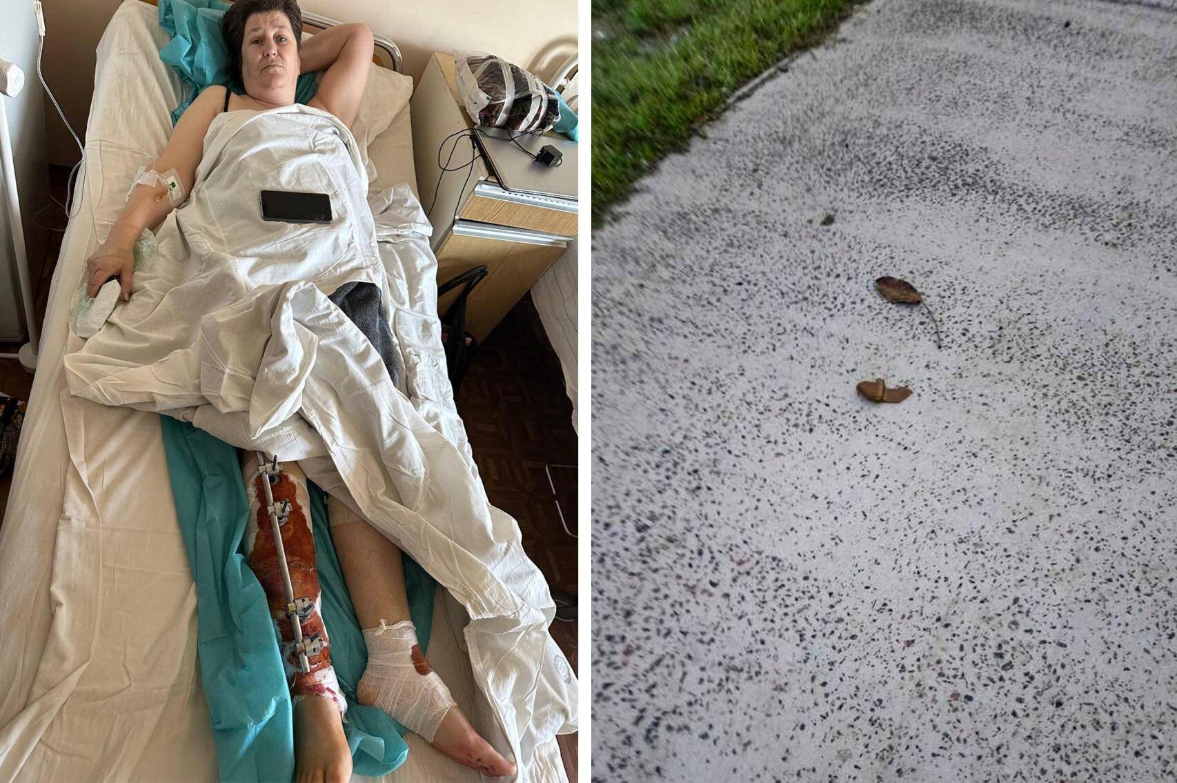 Tatiana à l'hôpital après l'attaque par drone