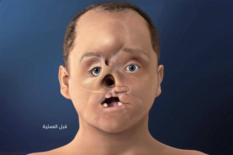 Derek Faf avant la transplantation faciale