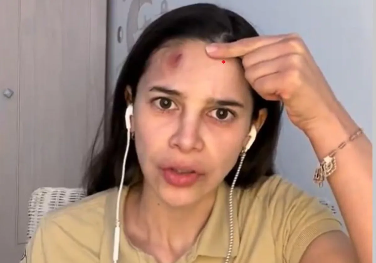 La serveuse montre la blessure sur son front suite à l'agression.