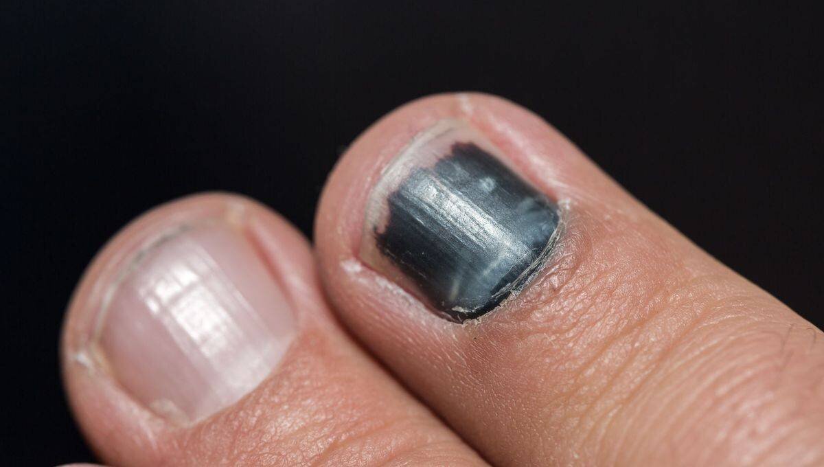 Ongle bleu : comment soulager la douleur efficacement ?