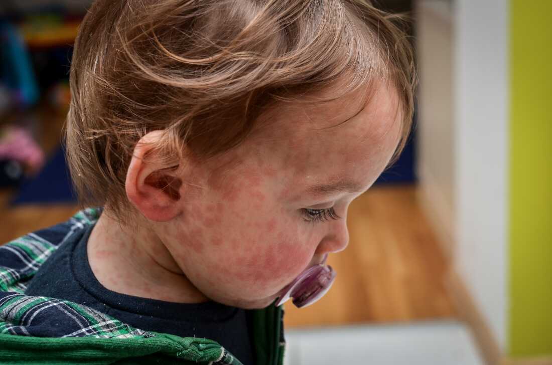 La plupart des enfants se rétablissent de la rougeole. Mais le virus peut être mortel et effacer la mémoire du système immunitaire.