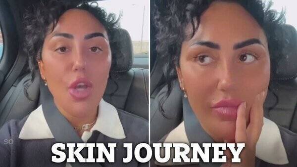 Sophie Kasaei après dissolution des fillers