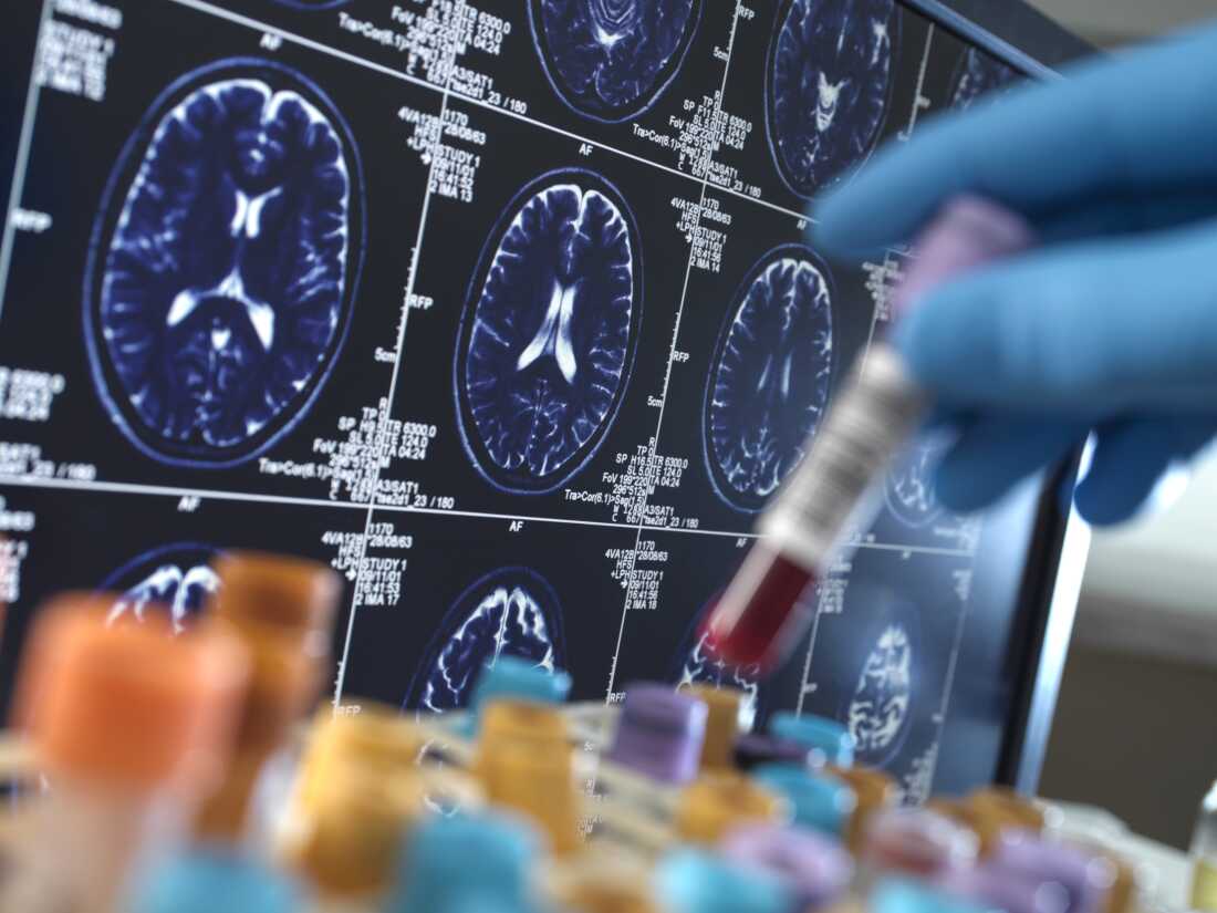 Tests sanguins et de liquide céphalorachidien pour Alzheimer