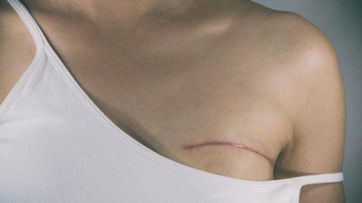 En France, un tiers des cancers diagnostiqués chez les femmes sont des cancers du sein.