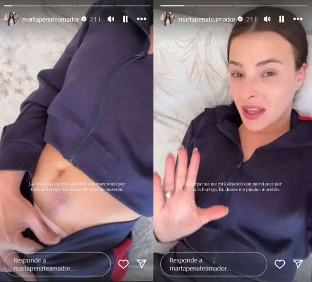 Marta Peñate partage ses stories Instagram montrant les effets du traitement