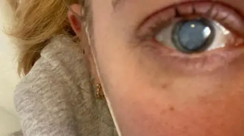 Œil droit d'Ellie Irwin avec cataracte visible