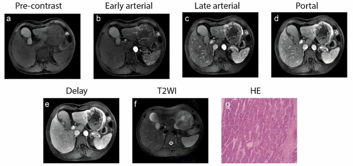 IRM montrant un carcinome hépatocellulaire chez un patient de 48 ans