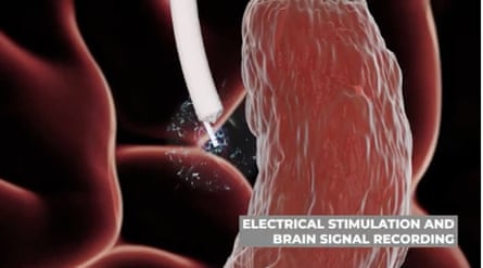 Image générée par ordinateur d'un minuscule cathéter crânien pénétrant dans le tissu cérébral