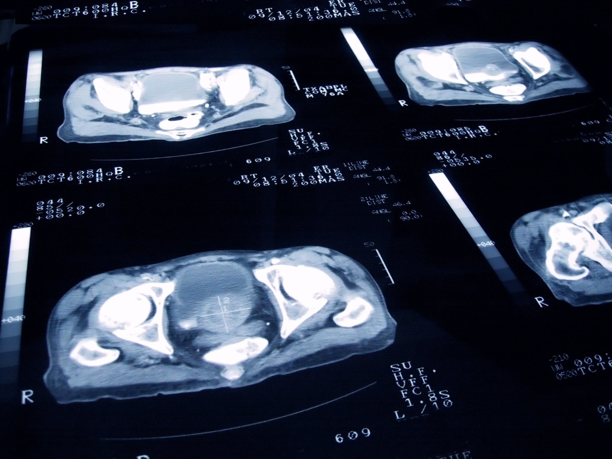 Différents types de cancers étudiés pour le dépistage sanguin, y compris la leucémie