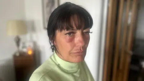 Paula Harrison avec des rougeurs sous les yeux