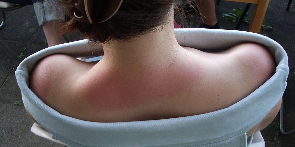 Cou d’une personne au soleil, montrant des marques de bronzage et de coup de soleil