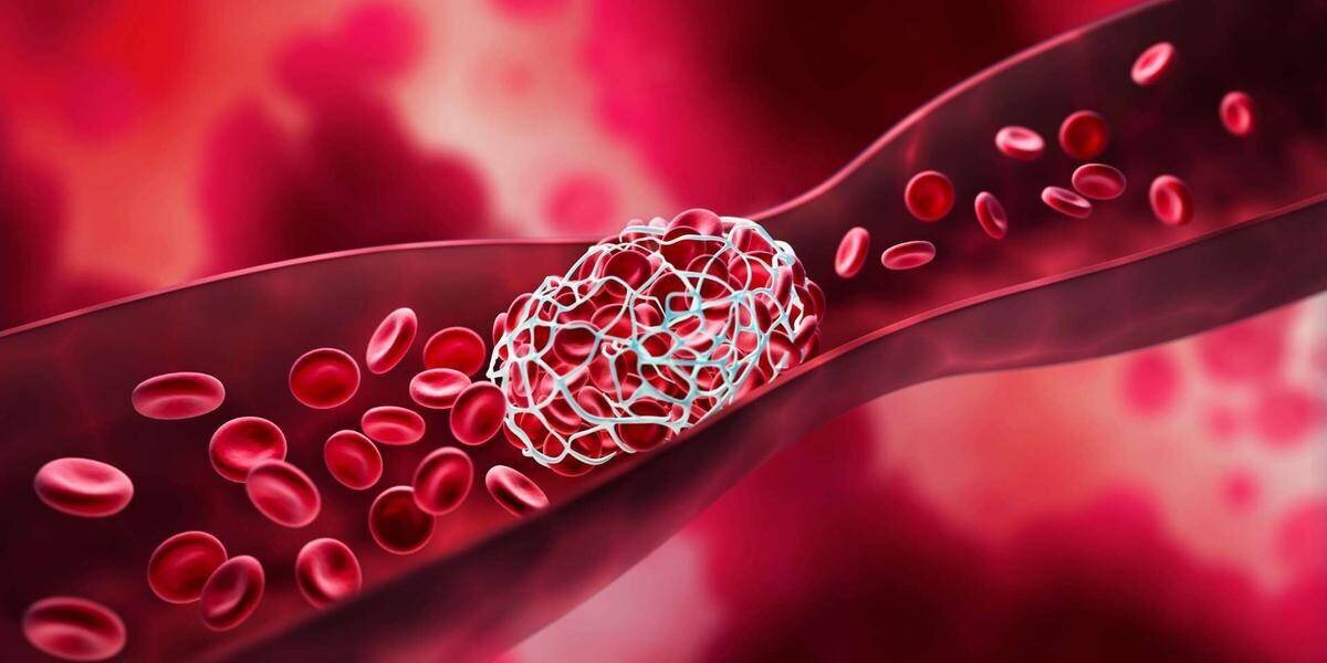 Photo associée à l'étude sur les marqueurs de récidive de la MTEV