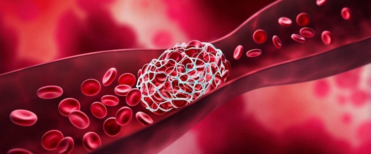 Illustration des marqueurs génétiques dans la MTEV