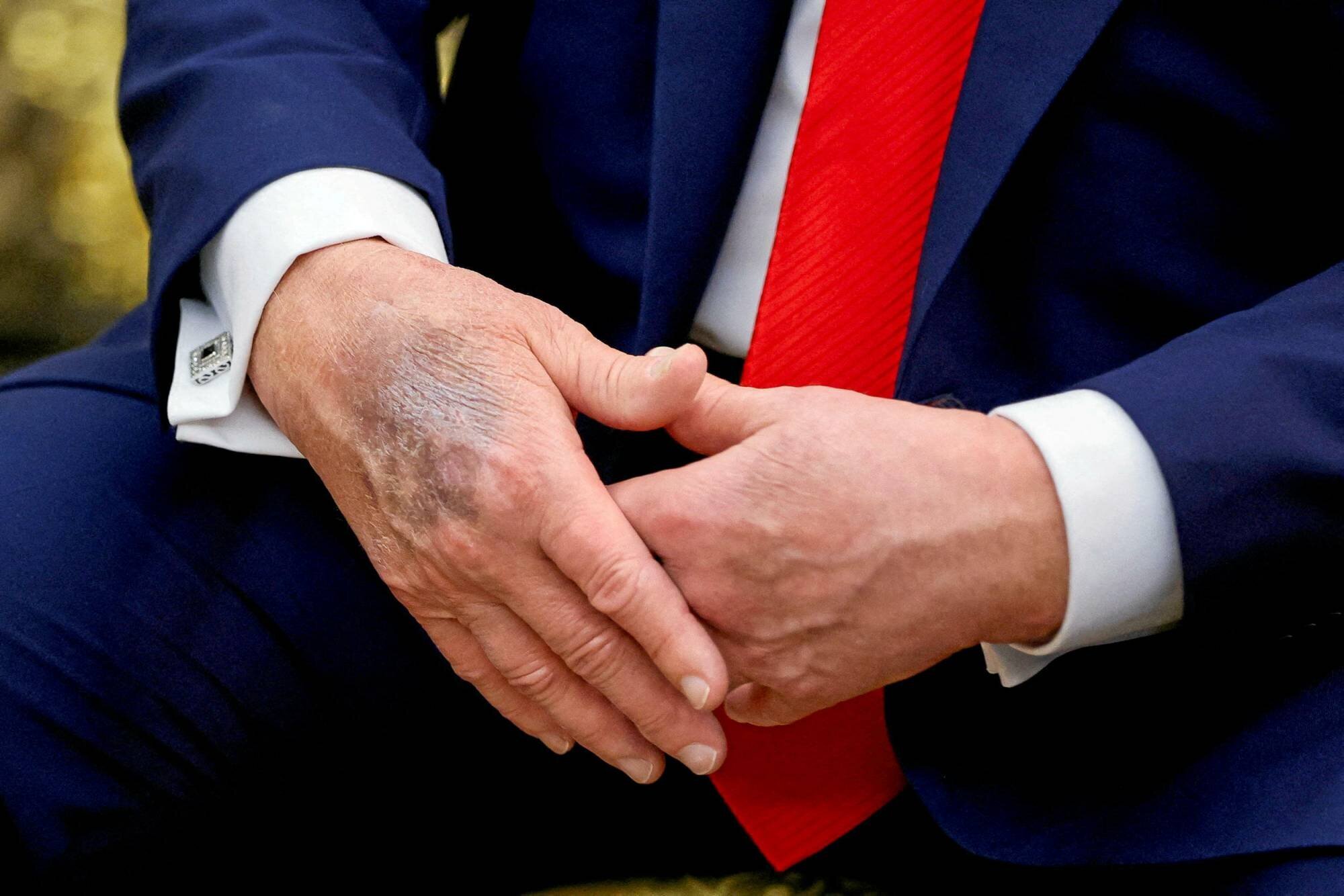 Ecchymose sur la main de Donald Trump