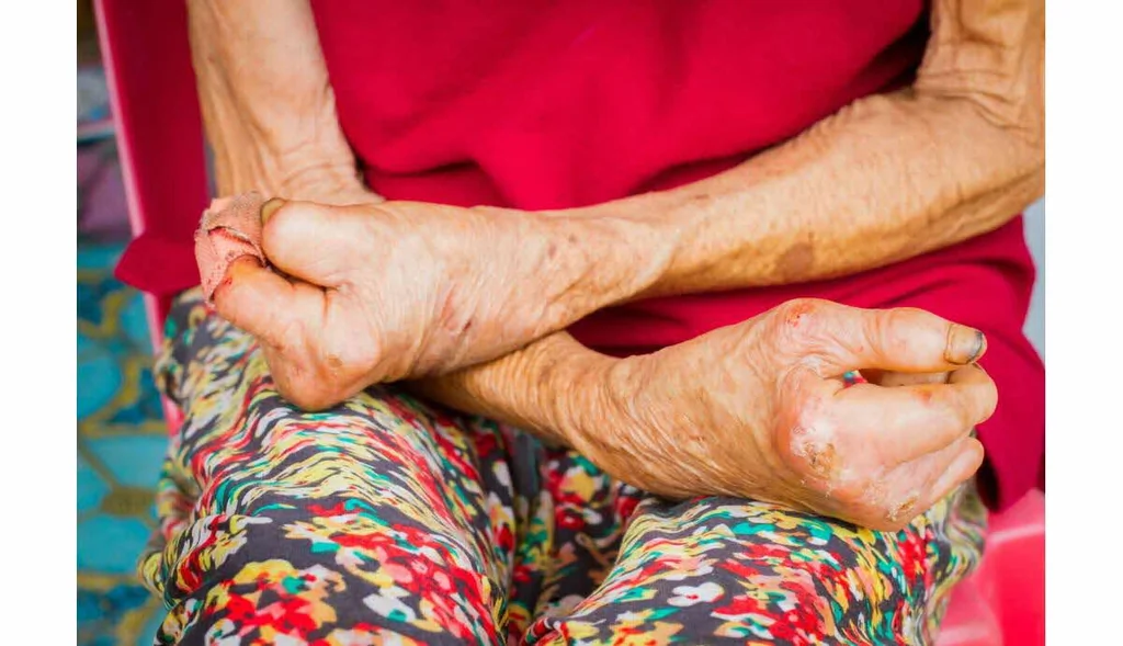 Lèpre en Roumanie: deux cas détectés dans un spa
