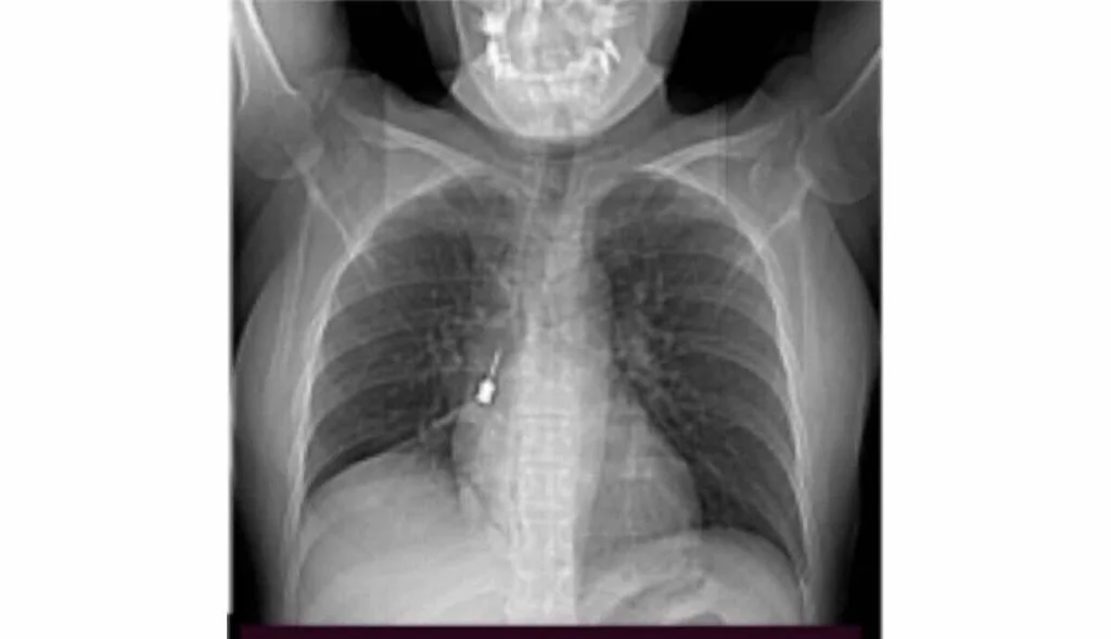 Italie: une patiente opérée après avoir avalé un tournevis dentaire