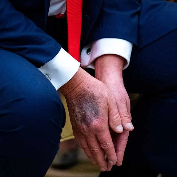 Trump explique les causes des hématomes sur sa main