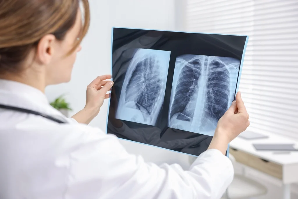 L’IA révolutionne la détection des tumeurs pulmonaires invisibles aux médecins