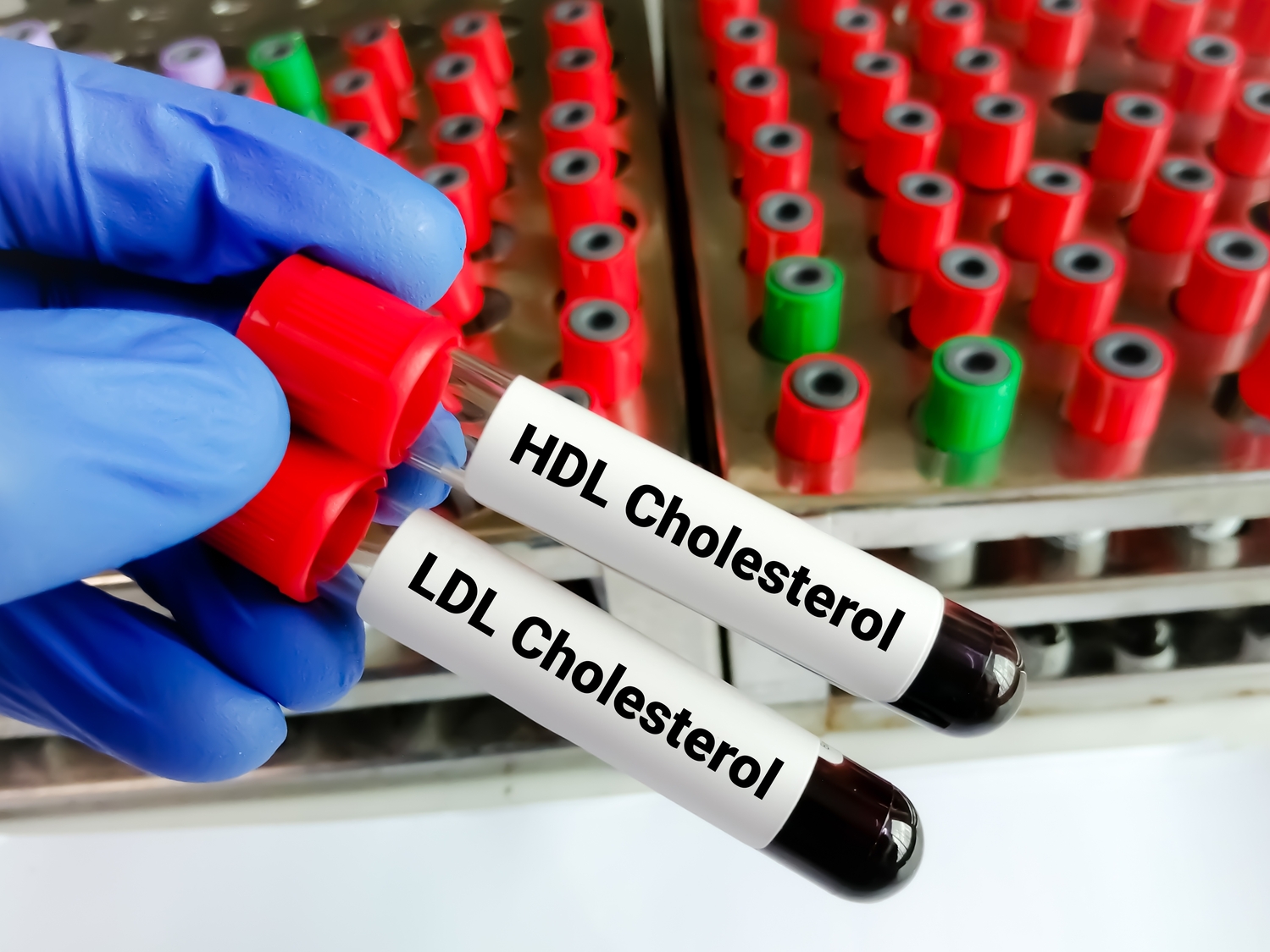 Cholestérol élevé : 4 conseils d’un cardiologue pour agir efficacement