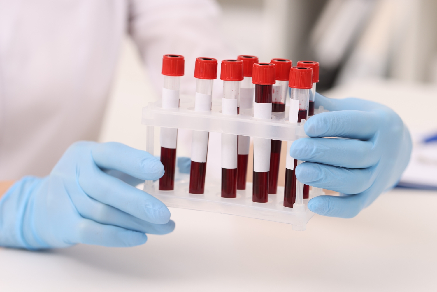 Test sanguin Galleri : détection précoce de 50 cancers révolutionnaire